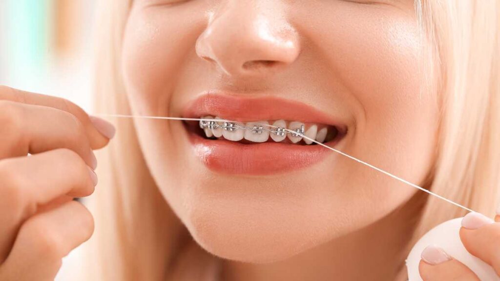 como passar o fio dental com aparelho